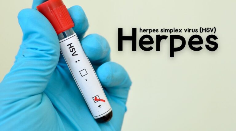 Herpes Simplex Virus : HSV